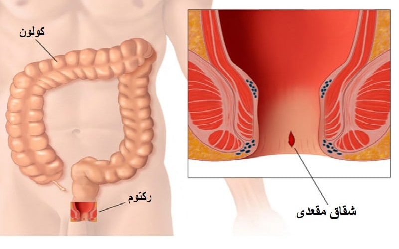 شقاق مقعدی چیست + روش‌های پیشگیری و درمان آن