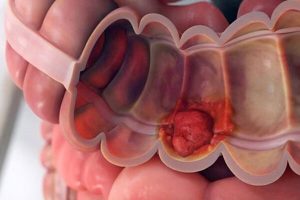 تشخیص زودهنگام سرطان روده با کاهش سن غربالگری