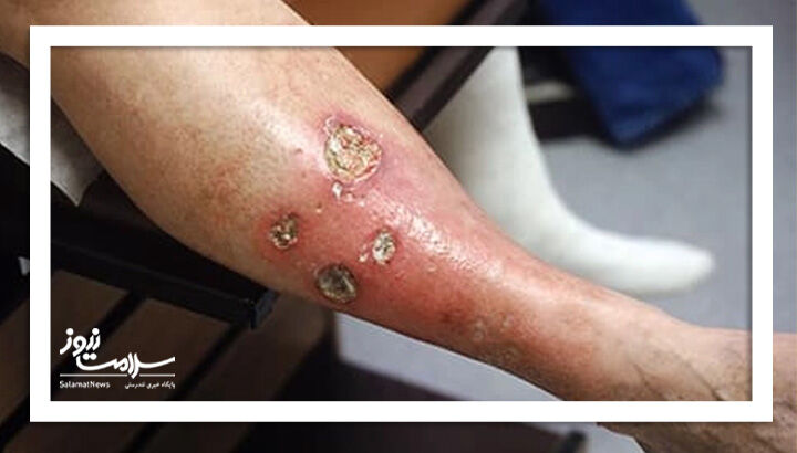 پیشگیری از زخم پای دیابتی با مراقبت‌های روزانه و معاینات منظم