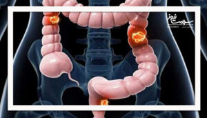 سرطان روده بزرگ؛ بررسی علل شیوع بیشتر در جوانان، علائم و نکات پیشگیری
