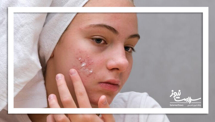 چند ماده غذایی که اکنه را فعال می‌کند