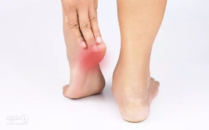 متخصص طب فیزیکی هشدار داد: درد پاشنه پای خود را به اشتباه «خار پاشنه» نخوانید؛ علت اصلی التهاب فاشیای کف پا است