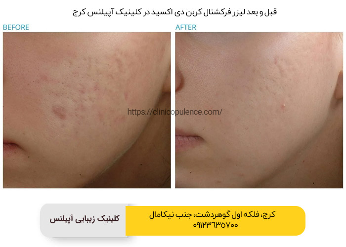 لیزر فرکشنال
